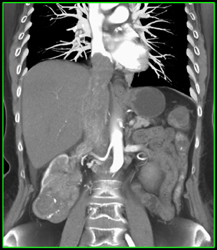 Renal Cell Carcinoma Invades Right Renal Vein and IVC - CTisus CT Scan