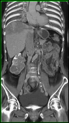 Renal Cell Carcinoma Invades the Inferior Vena Cava (IVC) and Extends Into the Right Atrium - CTisus CT Scan