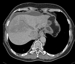 Tumor Also Extends Into the Hepatic Veins - CTisus CT Scan