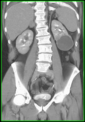 Small Renal Cell Carcinoma Near Cyst - CTisus CT Scan