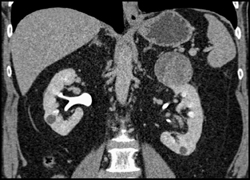 Cystic Renal Cell Carcinoma - CTisus CT Scan