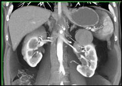 Cystic Renal Cell Carcinoma - CTisus CT Scan