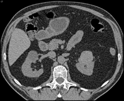 Cystic Renal Cell Carcinoma - CTisus CT Scan