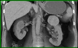 Cystic Renal Cell Carcinoma - CTisus CT Scan