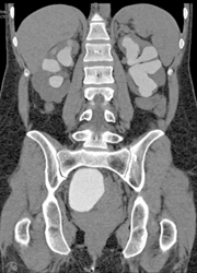 Ct Cystogram With Reflux - CTisus CT Scan