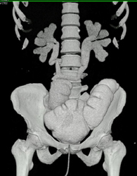 Ileal Loop With Hydronephrosis - CTisus CT Scan