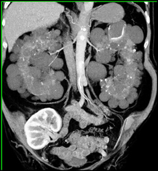 Normal Transplant Kidney in the Right Lower Quadrant - CTisus CT Scan