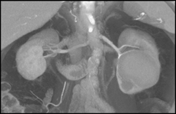 Hematoma in Left Kidney Due to Underlying Tumor - CTisus CT Scan