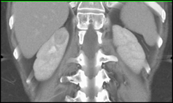 Renal Cell Carcinoma in Right Upper Pole - CTisus CT Scan