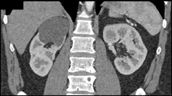 Renal Cyst - CTisus CT Scan