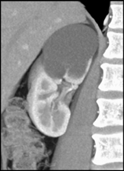 Renal Cyst - CTisus CT Scan