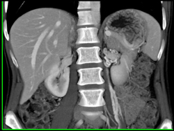 Prominent Arteries Near Left Renal Hilum - CTisus CT Scan