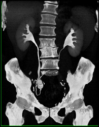 Ct Urogram Shows Ileal Loop - CTisus CT Scan