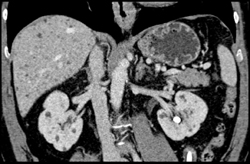 Early Pck and Pld - CTisus CT Scan