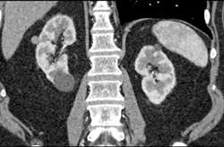 Renal Cyst Including A Few High Density Renal Cysts - CTisus CT Scan