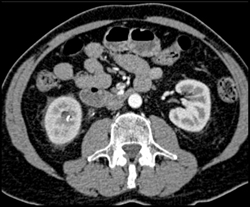 Perinephric Stranding on the Right Due to Stone Disease - CTisus CT Scan