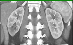 Decreased Enhancement Lower Pole Right Kidney-vascular in Nature - CTisus CT Scan