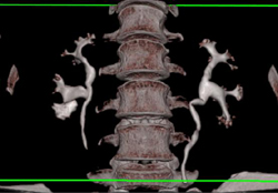 Blunted Lower Pole Calyx on the Right - CTisus CT Scan