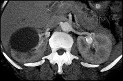 Left Renal Artery Aneurysm - CTisus CT Scan