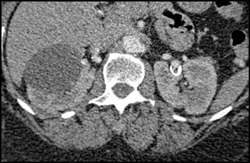 Left Renal Artery Aneurysm - CTisus CT Scan