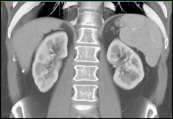 Arteriovenous Malformation (AVM) in Right Renal Pelvis-easy to Miss Without CT Angiography - CTisus CT Scan