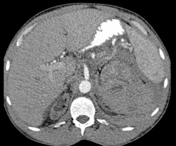 Spontaneous Bleed From An Occult Renal Cell Carcinoma - CTisus CT Scan