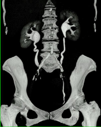 Dilated Renal Pelvis and Ureters Bilaterally - CTisus CT Scan