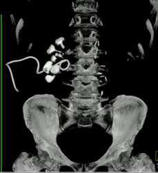 Nephrostomy Tube - CTisus CT Scan