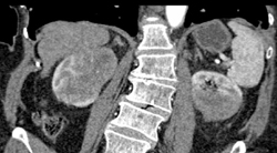 Metastatic Lung Cancer to Kidneys - CTisus CT Scan