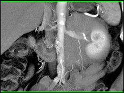 Renal Lymphoma - CTisus CT Scan