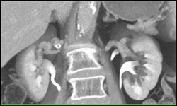 Right Renal Artery Aneurysm - CTisus CT Scan