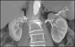 Right Renal Artery Aneurysm - CTisus CT Scan