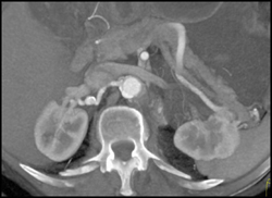 Right Renal Artery Aneurysm - CTisus CT Scan