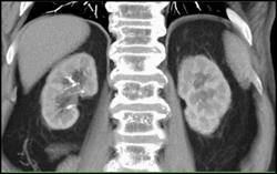 Decreased Enhancement to Right Kidney Due to Arterial Disease - CTisus CT Scan