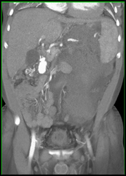 Perirenal Bleed S/P Bx - CTisus CT Scan