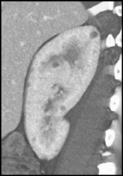 Early Polycystic Kidney Disease - CTisus CT Scan