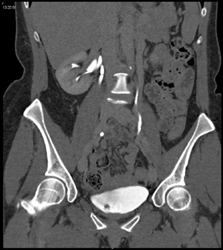 1 Cm Bladder Cancer - CTisus CT Scan