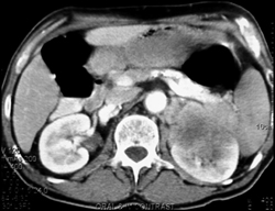 Renal Lymphoma With Splenic Involvement - CTisus CT Scan