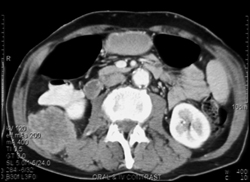 Melanoma Metastatic to Right Pararenal Space - CTisus CT Scan