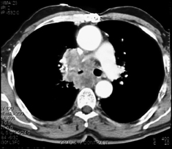 Metastatic Renal Cell Carcinoma - CTisus CT Scan