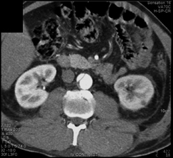 Aortic Dissection Involves Left Renal Artery With Decreased Enhancement - CTisus CT Scan