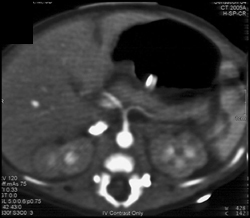 Renal Failure in Neonate - CTisus CT Scan