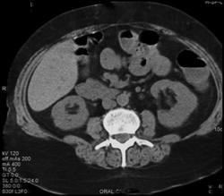 Halo in Left Renal Pelvis C/w Tuberculosis (TB) - CTisus CT Scan