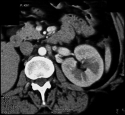 Renal Artery Aneurysm - CTisus CT Scan