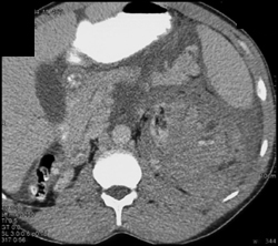 Spontaneous Renal and Perirenal Bleed in End Stage Kidney Disease - CTisus CT Scan