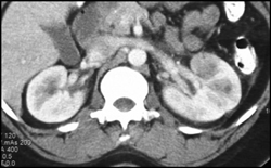 Acute Pyelonephritis - CTisus CT Scan