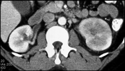 Acute Pyelonephritis - CTisus CT Scan