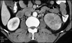 Acute Pyelonephritis - CTisus CT Scan