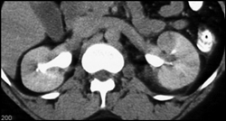 Acute Pyelonephritis - CTisus CT Scan