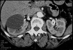 Left Renal Artery Aneurysm - CTisus CT Scan